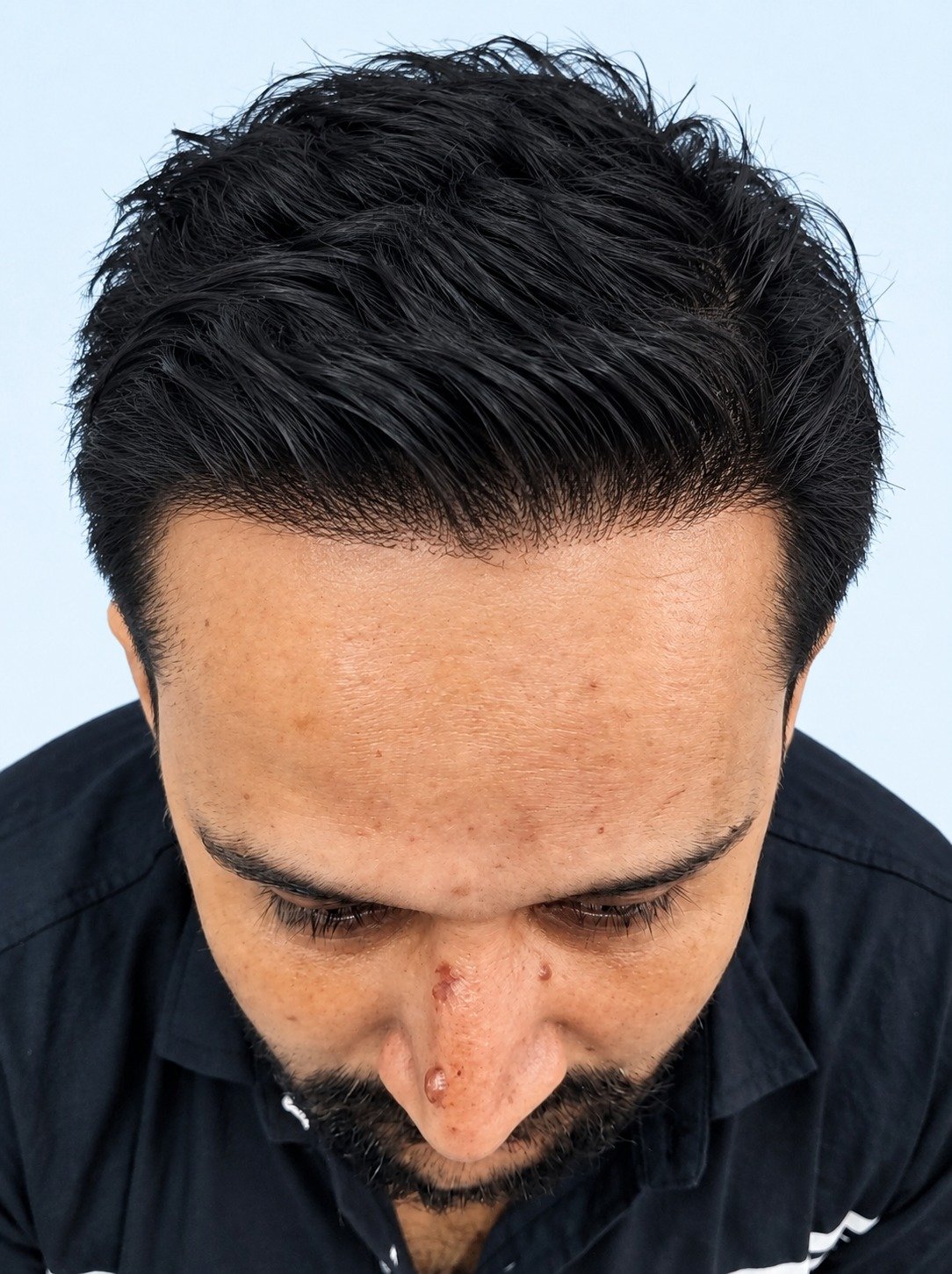 After hair transplant - crown thinning - 12 months