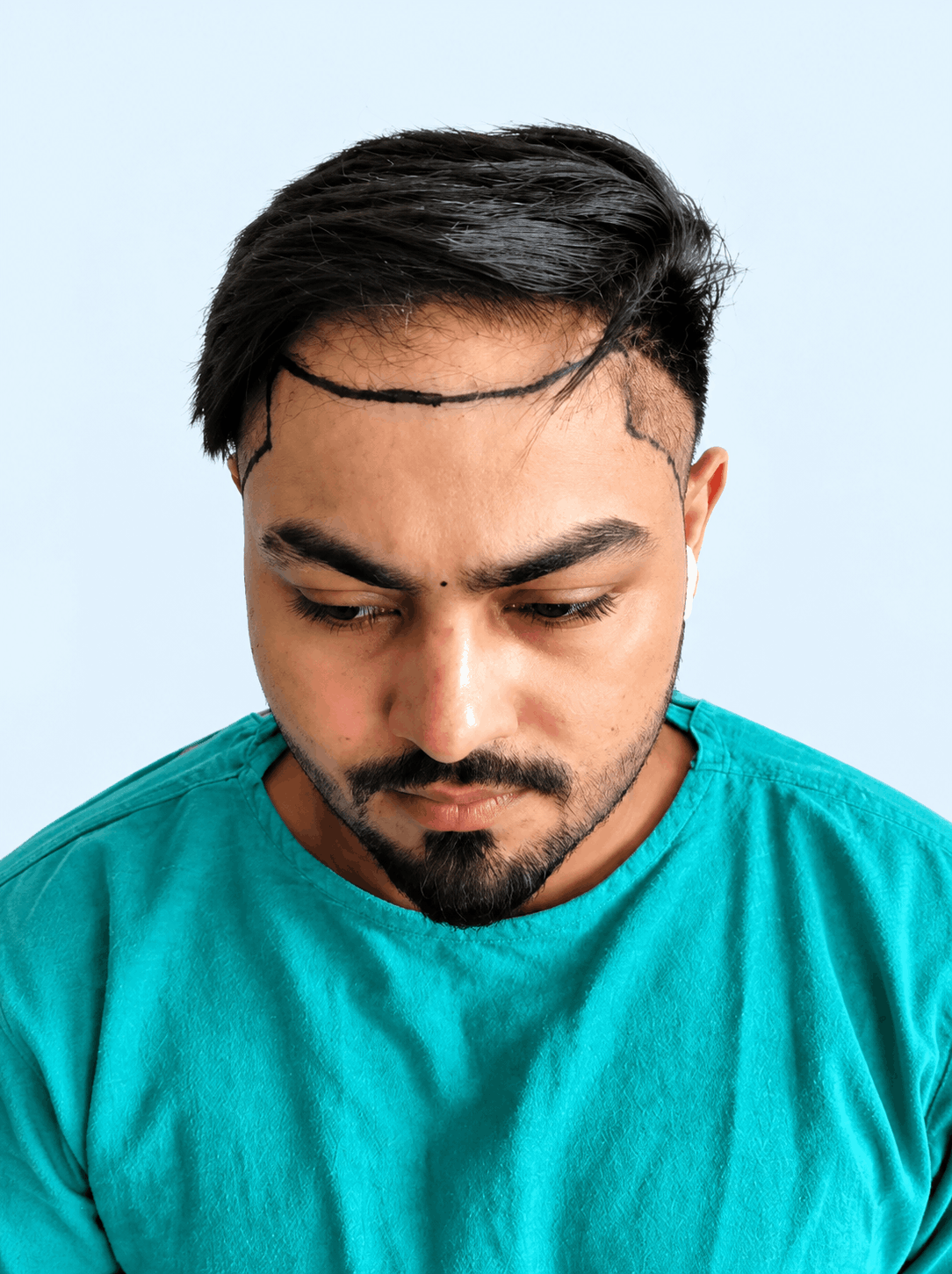 Before hair transplant - advanced baldness