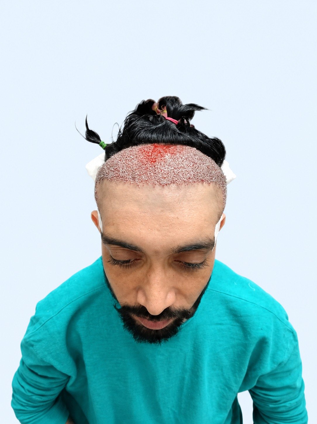 Before hair transplant - receding hairline
