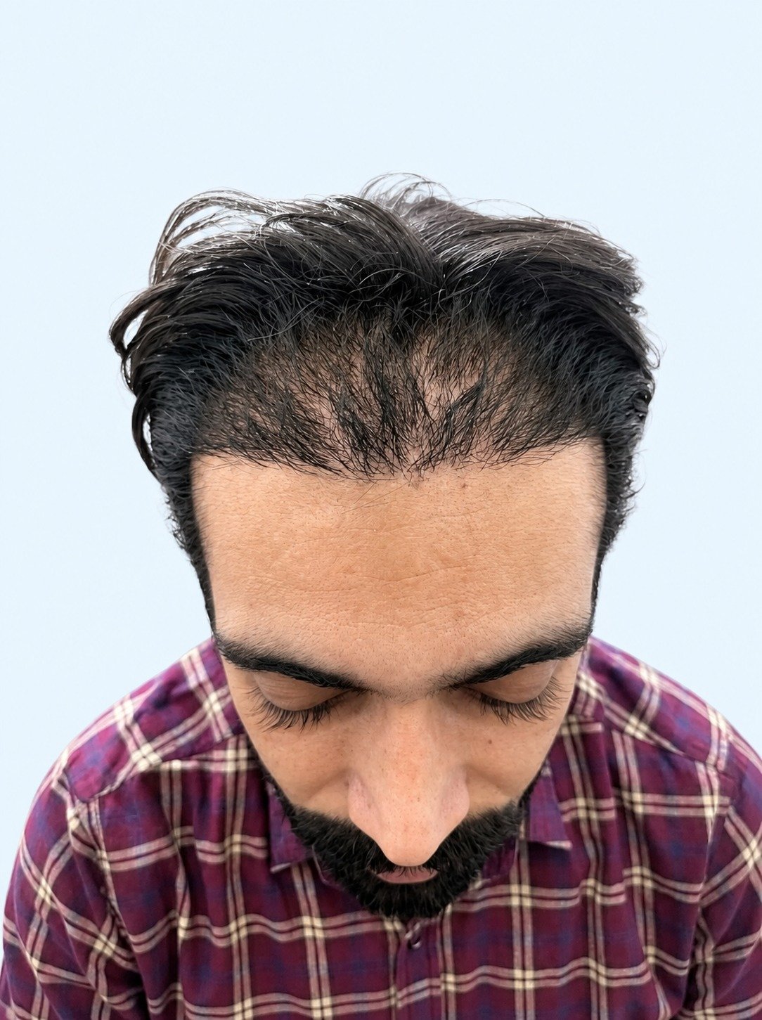 After hair transplant - receding hairline - 12 months
