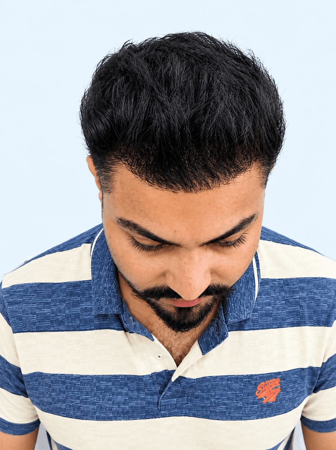 After hair transplant - advanced baldness - 12 months